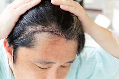 Person with staples in their head after a brain surgery shows off the scar